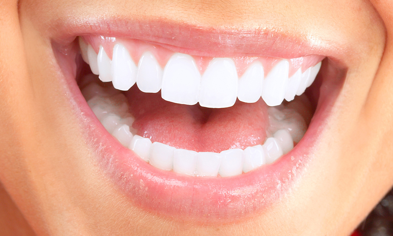 Tandenbleekbehandeling(en)