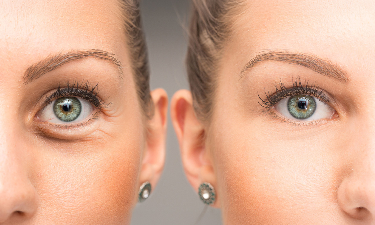 HIFU facelift-behandeling voor zone naar keuze