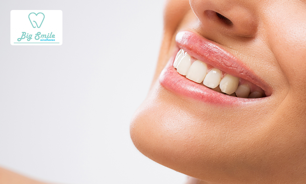 Tandenbleekbehandeling(en) + evt. polijsten