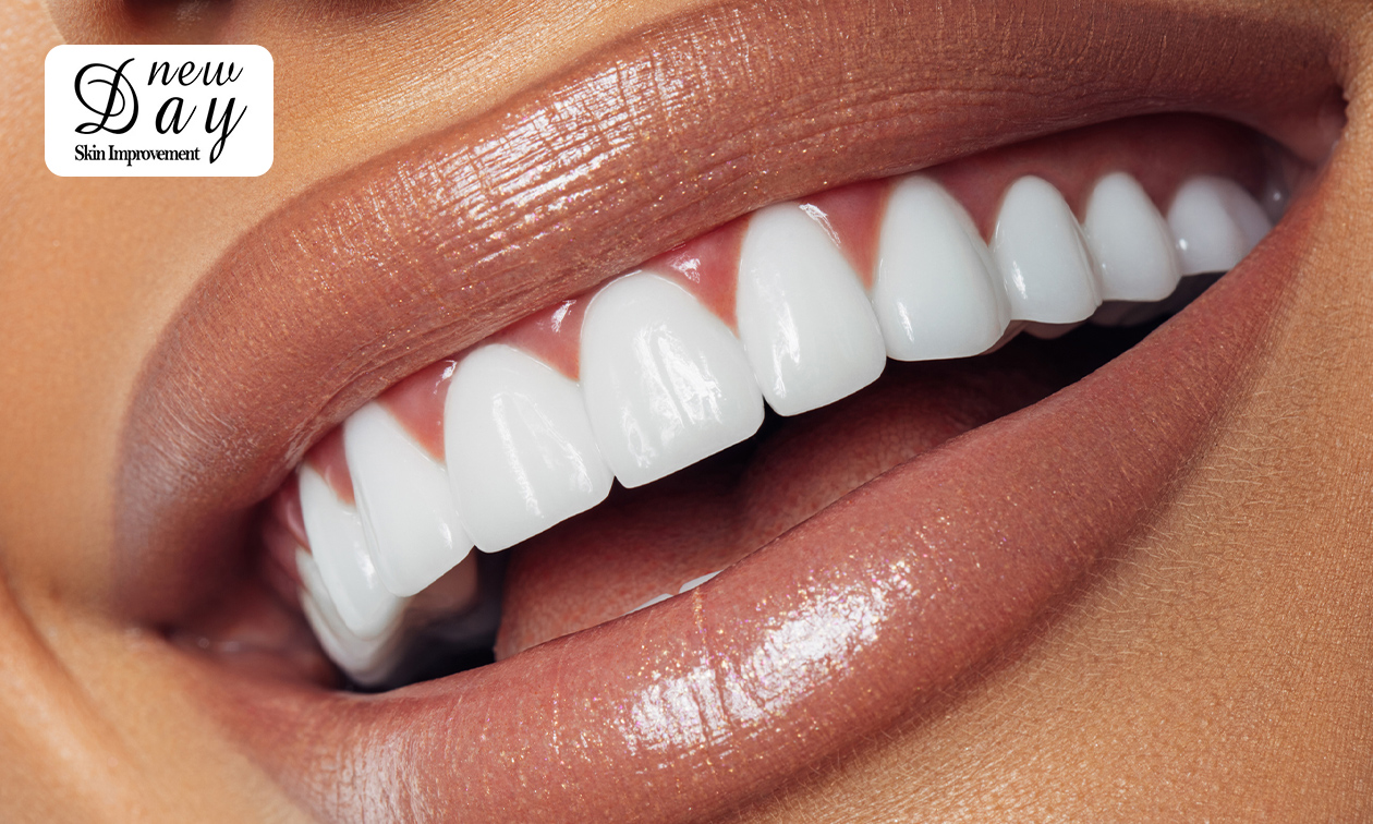 3 of 5 tandenbleekbehandeling(en) + evt. polijsten