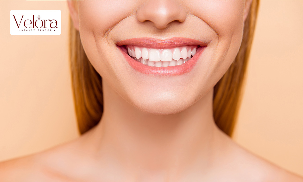 1 oder 5 kosmetische Zahnaufhellung(en) in Düsseldorf (je 30 Min.)